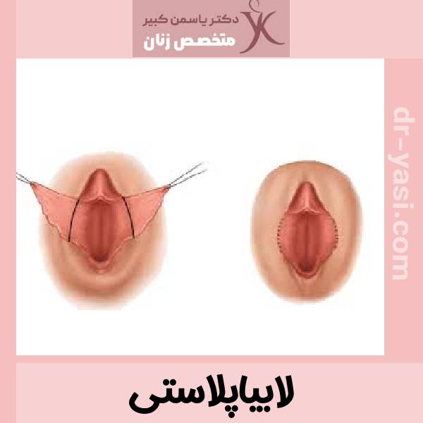 لابیاپلاستی