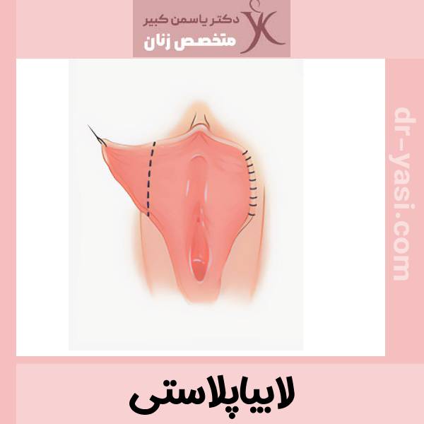 عکس عمل لابیاپلاستی