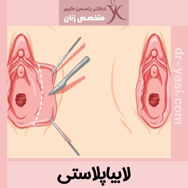 عکس لابیاپلاستی